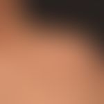 Kaposi's sarcoma epidemic (overview): HIV-associated Kaposi's sarcoma with disseminated, bizarrel...