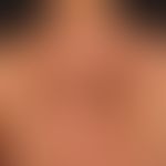 Kaposi's sarcoma epidemic (overview): HIV-associated Kaposi's sarcoma with disseminated, bizarrel...
