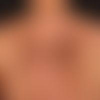 Kaposi's sarcoma epidemic (overview): HIV-associated Kaposi's sarcoma with disseminated, bizarrel...