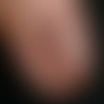 Melanonychia striata longitudinalis. approx. 0.4 cm wide, dark brown strip of the nail. nail fold...