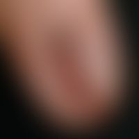 Melanonychia striata longitudinalis. approx. 0.4 cm wide, dark brown strip of the nail. nail fold...