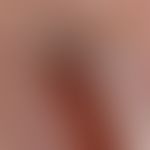 Melanonychia striata longitudinalis (detailed picture): approx. 0.4 cm wide, dark brown strip of ...