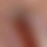 Melanonychia striata longitudinalis (detailed picture): approx. 0.4 cm wide, dark brown strip of ...