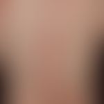 Epidermolysis bullosa acquisita: generalisiertes Krankheitsbild (DD. Bullöses Pemphigoid)&nbsp;mi...