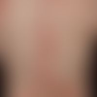 Epidermolysis bullosa acquisita: generalisiertes Krankheitsbild (DD. Bullöses Pemphigoid)&nbsp;mi...