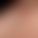 Apokrine Hidradenome: rötliche&nbsp;bzw. bläulich tingierte, feste, völlig symptomlose, scharf be...