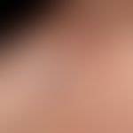 Apocrine hidradenomas: reddish or bluish tinged, firm, completely symptomless, sharply defined, s...