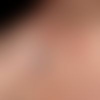 Apocrine hidradenomas: reddish or bluish tinged, firm, completely symptomless, sharply defined, s...