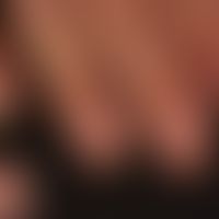 Graham-Little syndrome: pronounced scarring (10 nail) onychodystrophy and lymphocytic, scarring a...
