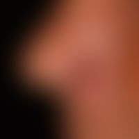 Basal cell carcinoma destructive: slowly progressive basal cell carcinoma with destruction of the...