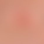 Basalzellkarzinomsklerodermiformes (Detailaufnahme):&nbsp; Pfeile markieren randliche bizarre&nbs...
