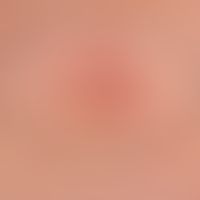 Basalzellkarzinomsklerodermiformes (Detailaufnahme):&nbsp; Pfeile markieren randliche bizarre&nbs...