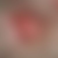 Basal cell carcinoma nodular: bulbous, felted, borderline erosive, white-reddish, firm, painless,...