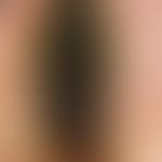 Tinea unguium (incident light microscopy): black dyschromia of the nail plate localized at the ri...