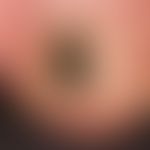 Tinea unguium:black dyschromia of the nail plate localizedonthe right big toe of a 42-year-old ma...