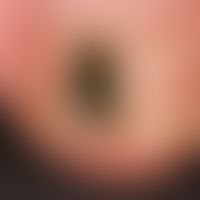 Tinea unguium:black dyschromia of the nail plate localizedonthe right big toe of a 42-year-old ma...