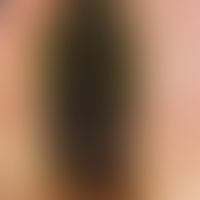 streaky "black coloration" of the big toe nail. the finding has been unchanged for > 1 year. g...