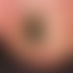 streaky black coloration of the big toe nail. the finding is unchanged since > 1 year. here st...