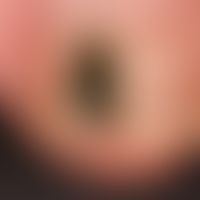 streaky black coloration of the big toe nail. the finding is unchanged since > 1 year. here st...