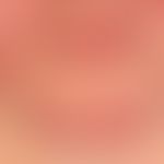 Rosacea papulopustulosa: grouped, inflammatory reddened papules and pustules that persist for wee...