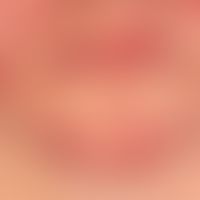 Rosacea papulopustulosa: grouped, inflammatory reddened papules and pustules that persist for wee...