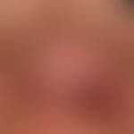 Diffuse rhinophyma: massive shape disturbance of the nose with bulbous-lobed phymic formation, be...