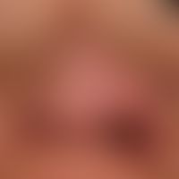 Diffuse rhinophyma: massive shape disturbance of the nose with bulbous-lobed phymic formation, be...