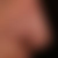 Diffuse rhinophyma: massive shape disturbance of the nose with bulbous-lobed phymic growth.
