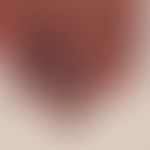 Raynaud's phenomenon:Raynaud's syndrome known for several years. No indication of systemic sclero...