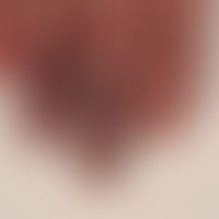 Raynaud's phenomenon:Raynaud's syndrome known for several years. No indication of systemic sclero...