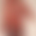 Raynaud's phenomenon: Raynaud's syndrome known for several years. No indication of systemic scler...