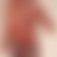 Raynaud's phenomenon: Raynaud's syndrome known for several years. No indication of systemic scler...