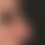 Rosazea: beginnende wulstige Veränderung der Nase (Rhinophymbildung)
