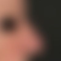 Rosacea: beginning bulging of the nose (rhinophyma)
