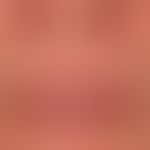 Perioral dermatitis: dermatitis of the prior facial skin with follicular papules and pustules tha...