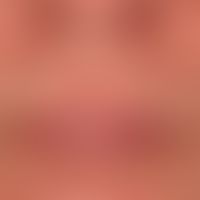 Perioral dermatitis: dermatitis of the prior facial skin with follicular papules and pustules tha...