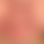 Dematitis periorale: extensive redness and swelling and scaling of the perioral and perinasal reg...