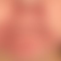 Dematitis periorale: extensive redness and swelling and scaling of the perioral and perinasal reg...