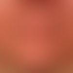 Dematitis periorale: reddening and swelling, multiple papules and some pustules. itching and feel...