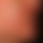 Dematitis periorale: reddening and swelling, multiple papules and some pustules. itching and feel...