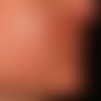 Dematitis periorale: reddening and swelling, multiple papules and some pustules. itching and feel...