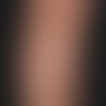 Pityriasis alba: großflächige, nicht symptomatische (kein Juckreiz), unscharf und unregelmäßig be...