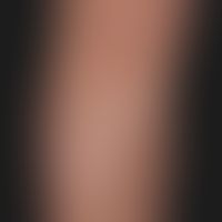 Pityriasis alba: large, non-symptomatic (no itching), blurred and irregularly limited white patch...