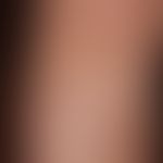Detailausschnitt: großflächige, nicht symptomatische (kein Juckreiz), unscharf und unregelmäßig b...