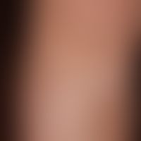 Detail: large, non-symptomatic (no itching), blurred and irregularly limited white spots (pseudol...