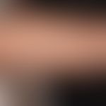 Pityriasis alba: &nbsp;großflächige, nicht symptomatische (kein Juckreiz), unscharf und unregelmä...