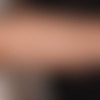 Pityriasis alba:  large, non-symptomatic (no itching), blurred and irregularly limited white patc...