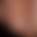 Onychophagie:&nbsp; Onychodystrophie durch Beißtätigkeit. Nagelhäutchen fehlt.&nbsp;
