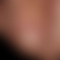 Onychophagie:&nbsp; Onychodystrophie durch Beißtätigkeit. Nagelhäutchen fehlt.&nbsp;
