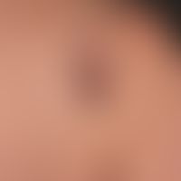 Melanoma malignes: unusually large, for years existing, only very slowly growing, completely symp...